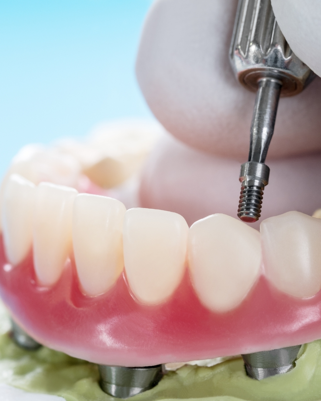 Protezy na implantach i miniimplantach Happy Dent Poznań